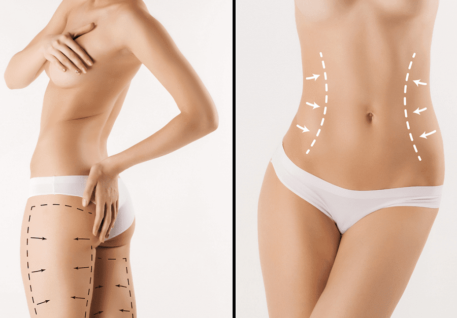The Need for Undergoing Tummy Tuck Surgery